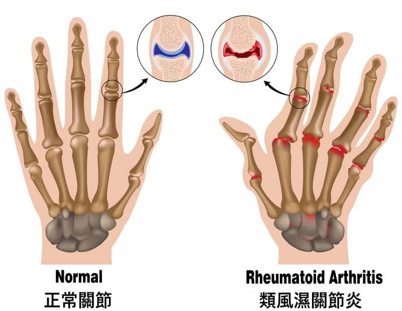 正常關節與類風濕關節炎的關節分別之處