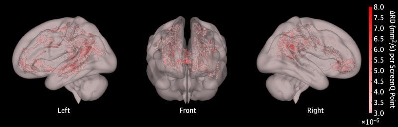 大腦「白質」是培養語言、讀寫和認知能的關鍵要素